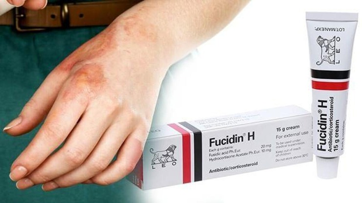 Fucidin Yanık İlacı Faydaları Ve Kullanımı