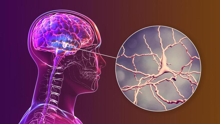 Gençlerde de görülüyor: Erken başlangıçlı demansın belirtileri ve teşhis zorlukları açıklandı!
