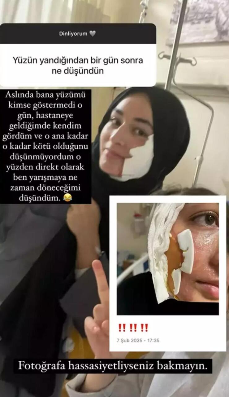 Beyza Aydın, yüzünün yanık halini paylaştı!